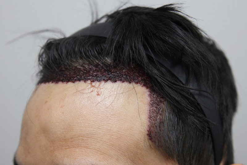 수술후1일3.jpg