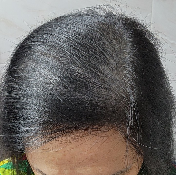 4. 수술후_6개월_셀카.jpg