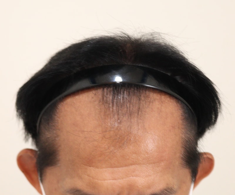 1. 수술전_2.JPG