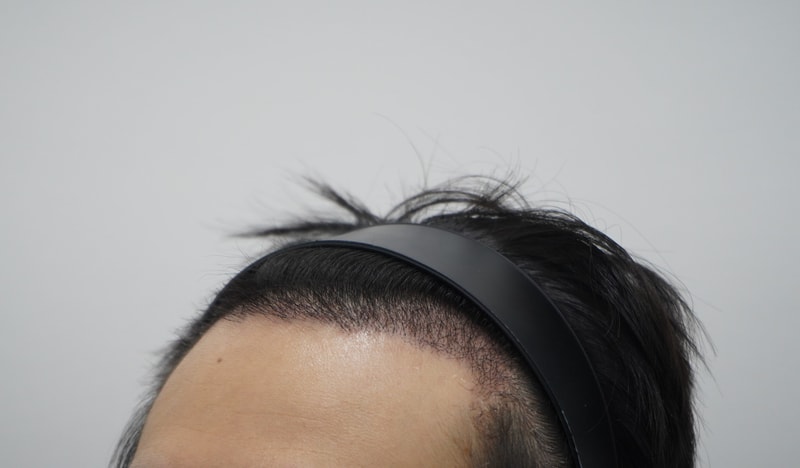 수술후 5주.jpg
