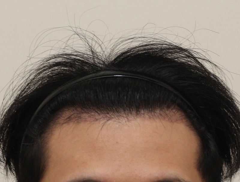 3. 수술후_3개월_1.JPG