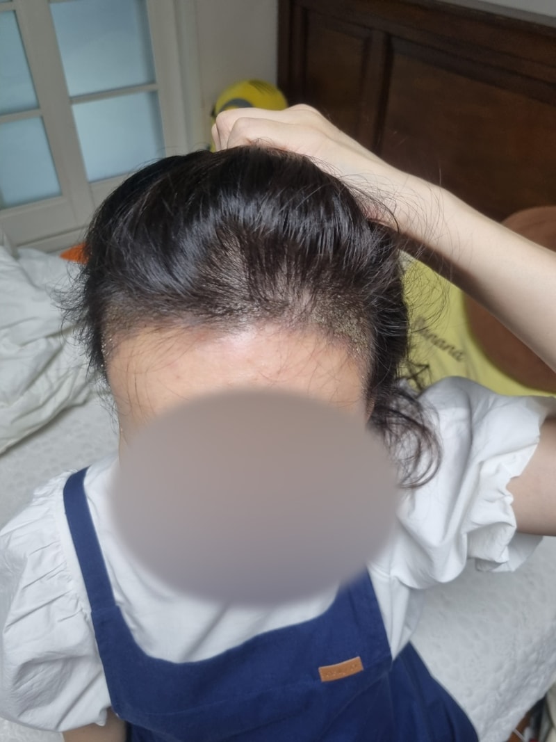 수술-10일-1.jpg
