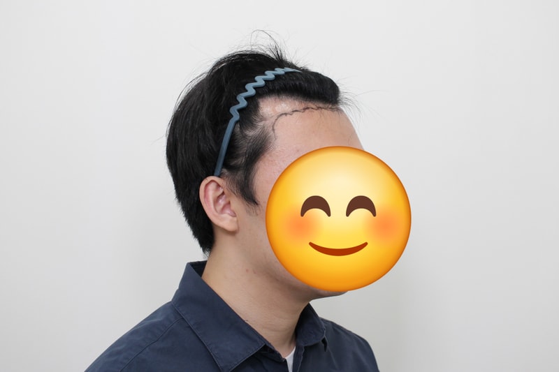 수술 전 옆모습.jpg