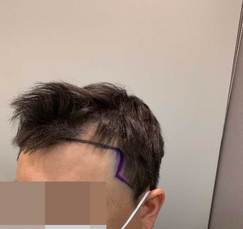 엠자이마 3600모 비절개모발이식 15개월 (다나성형외과)