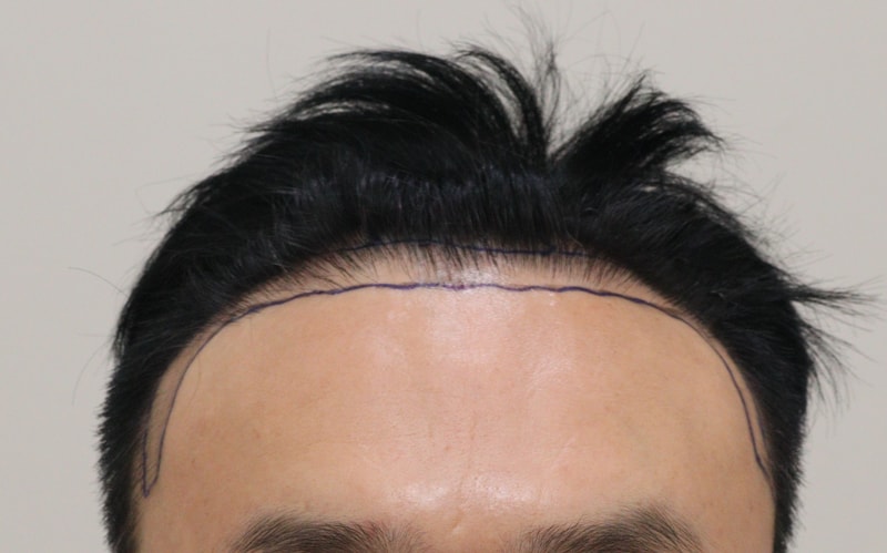 1. 수술전_1.JPG
