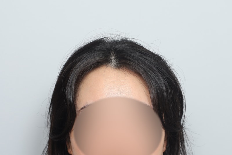 무삭발 헤어라인 모발이식 1000모낭 모원성형외과 박종옥원장님