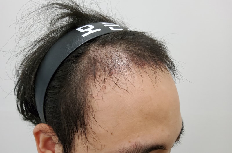 3. 수술후_3개월_3.jpg