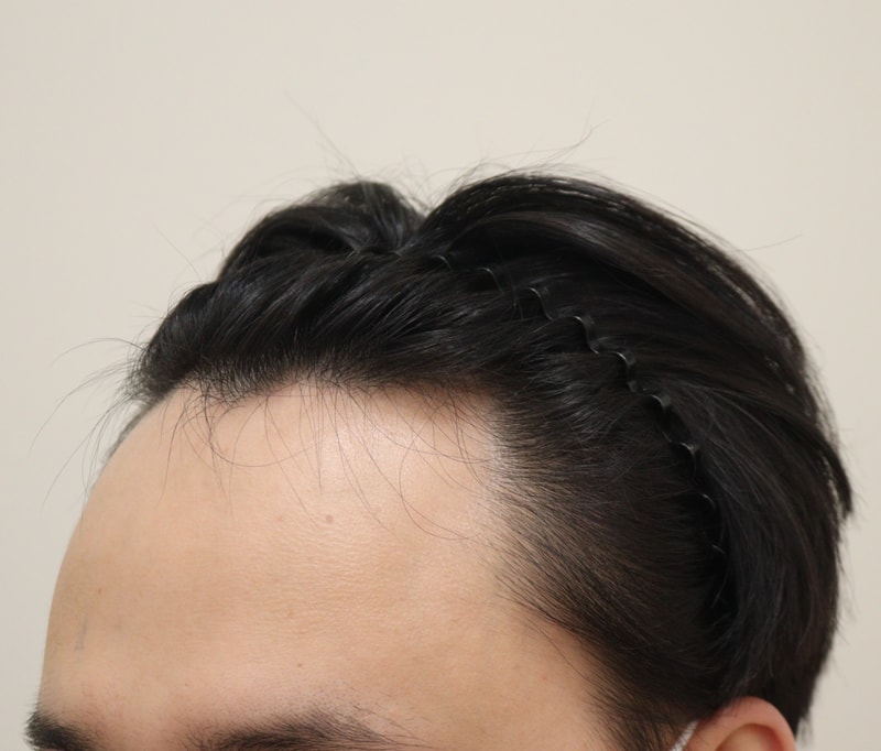 1. 수술전_3.JPG
