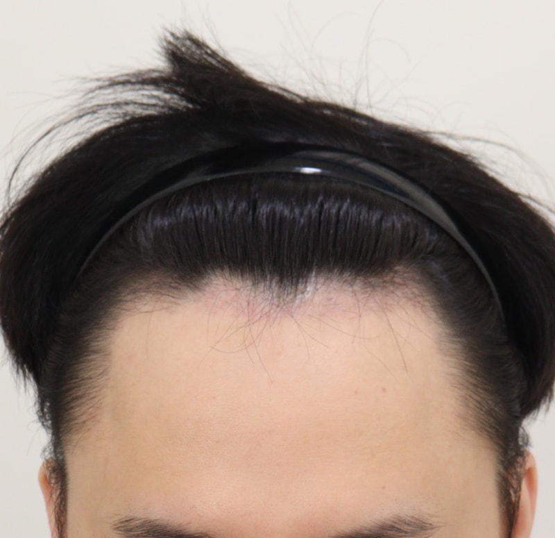 3. 수술후_3개월_2.JPG