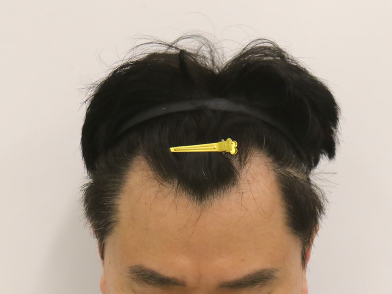 수술 전.JPG
