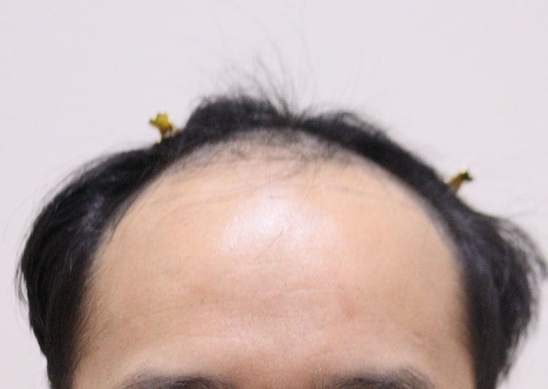1. 수술전_1.JPG