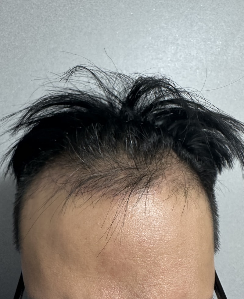 다나성형외과 비절개무삭발 60일경과 공유 ㅎㅎ 암흑기절정인듯