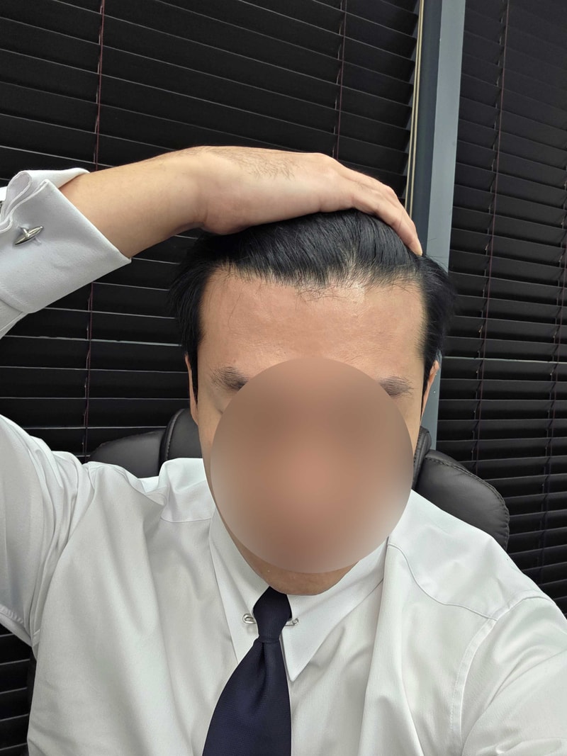 헤어라인 950모낭 모발이식 모원성형외과 5일차 찐후기!