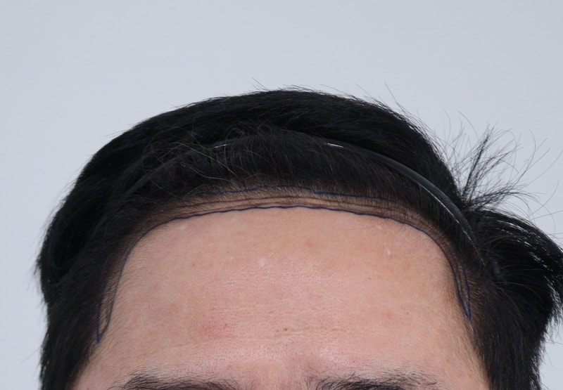 1. 수술전_1.JPG
