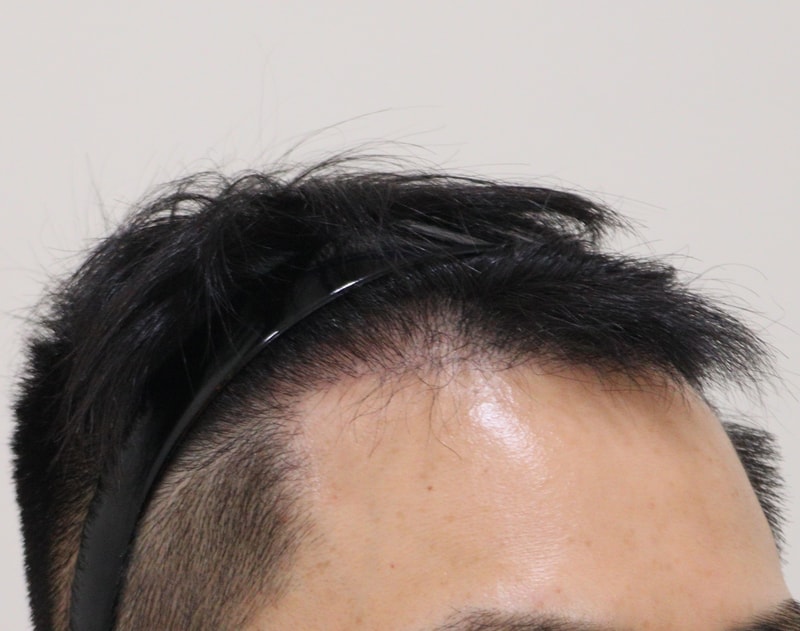 3. 수술후_6개월_3.JPG