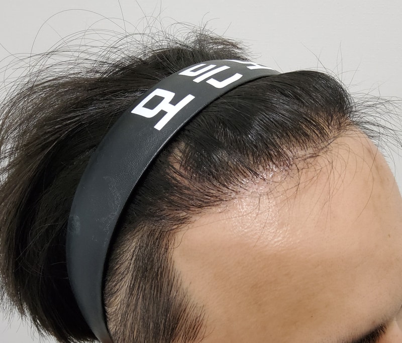 4. 수술후_6개월_4.jpg