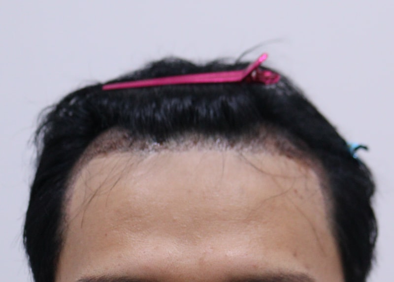 2. 수술후_1일_1.JPG