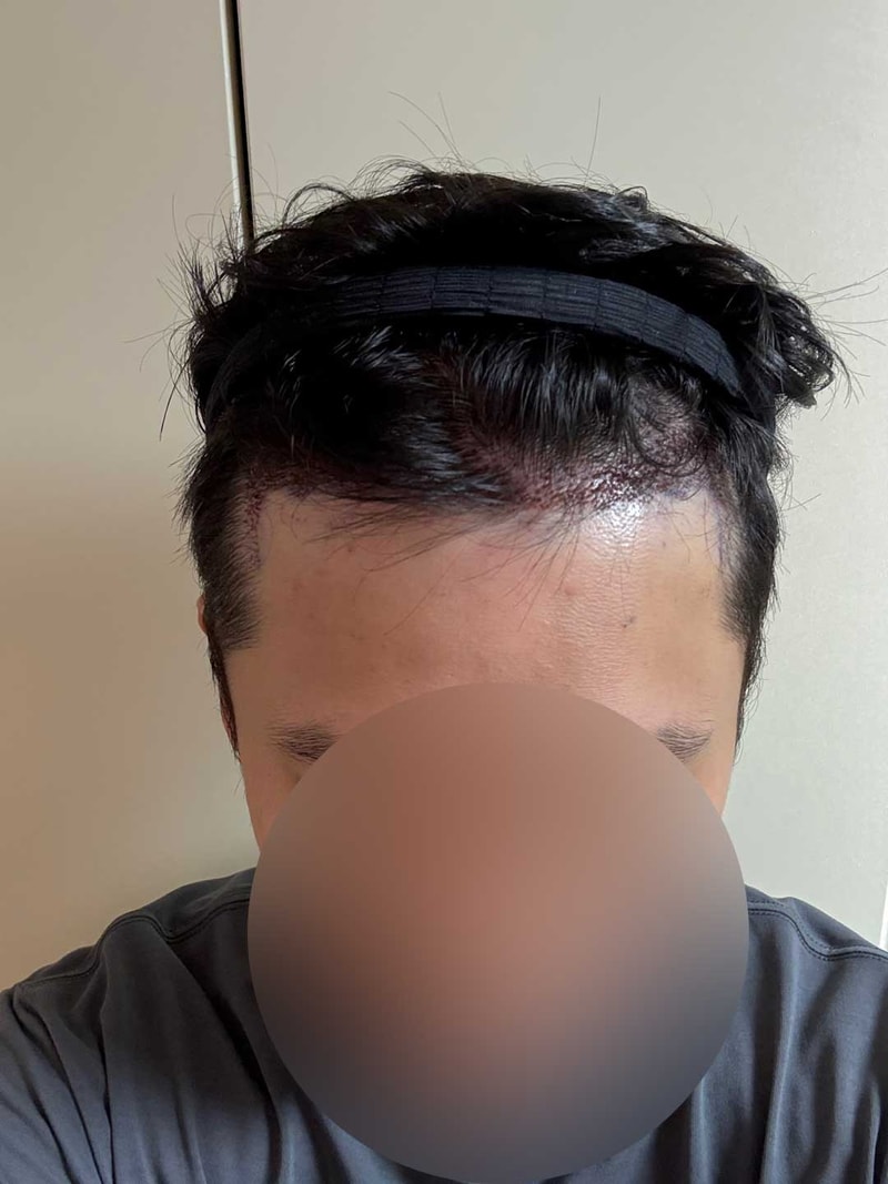 수술후에도 티 안나는 방법. 다나에서 수술 당일부터 3일차까지 공유요