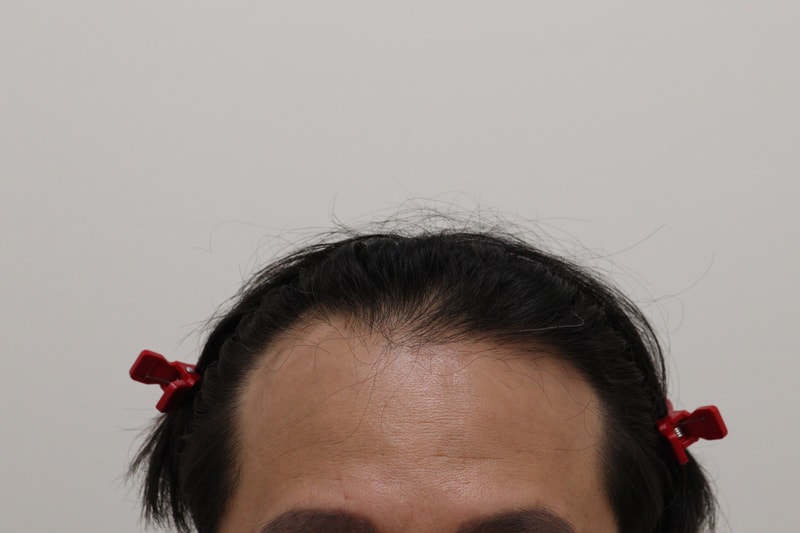 1. 수술전_1.JPG