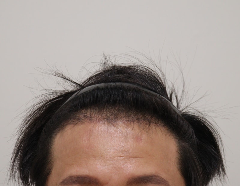 3. 수술후_6개월_1.JPG