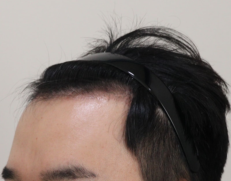 3. 수술후_4개월_2.JPG