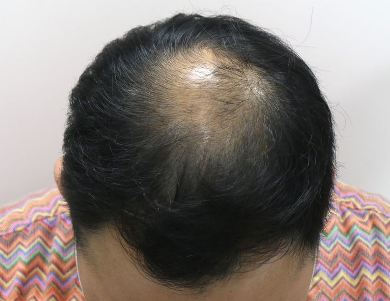 2.수술후.JPG