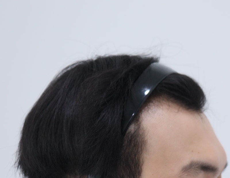 1. 수술전_3.JPG