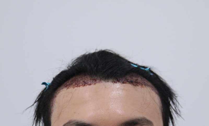 2. 수술후_1일_1.JPG