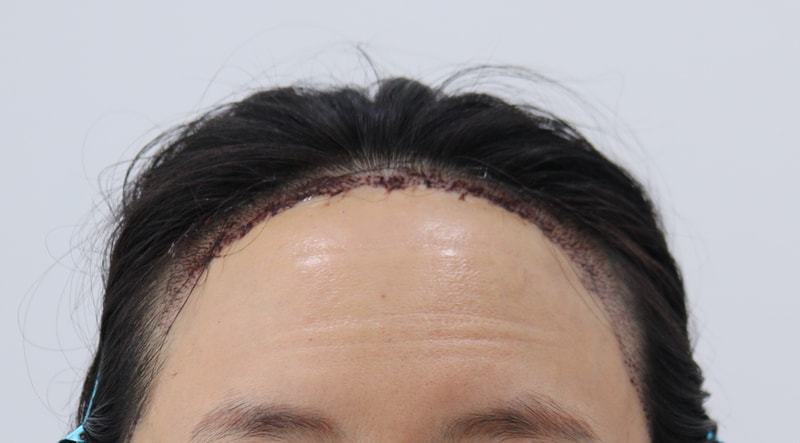 2. 수술후_1일_1.JPG