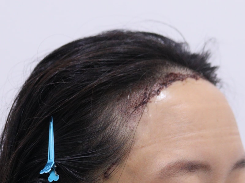2. 수술후_1일_3.JPG