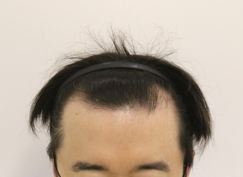 수술 전.JPG