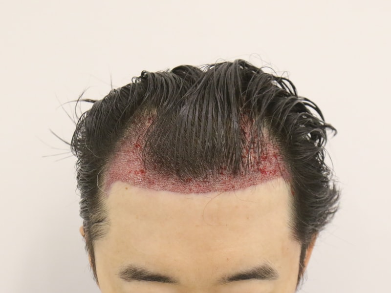 수술 후.JPG