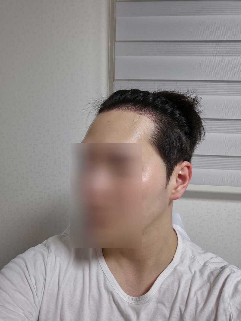 무삭발모발이식21일-2.jpg