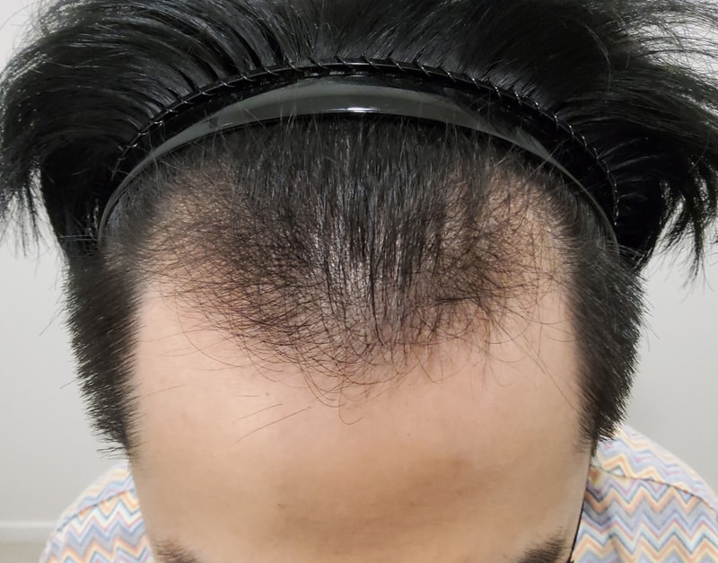 1. 수술전_1.jpg