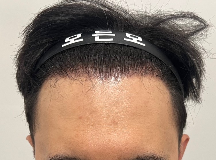 4. 수술후_6개월_1.jpg