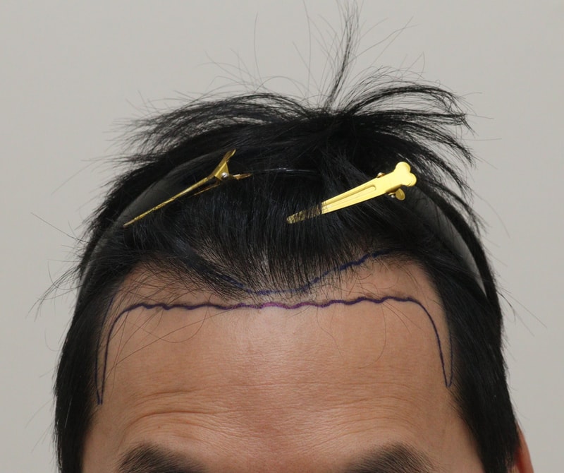 1. 수술전_1.JPG