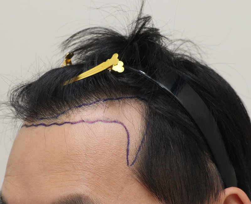 1. 수술전_2.JPG