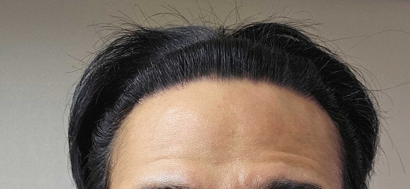 무삭발비절개+디자인 성공적. 다나에서 수술 후 21개월ㅎㅎ