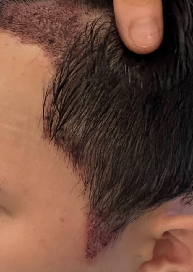 2. 수술후_1일_3.jpg