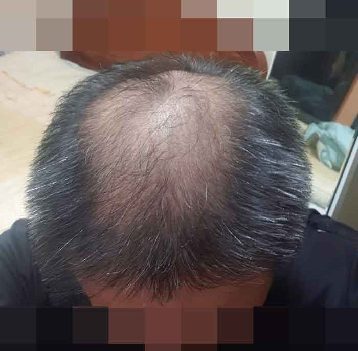 모발이식전.jpg
