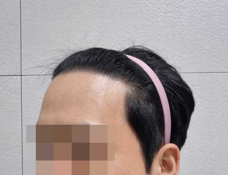 비절개.jpg