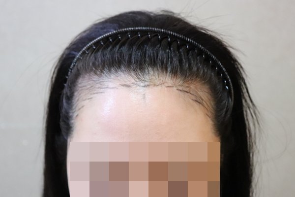 JP성형외과 절개 2500모 헤어라인 2주된 후기