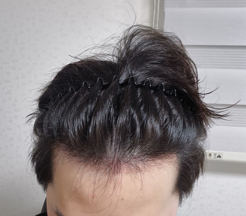 모발이식재수술 현실 후기 / 다나 비절개무삭발 1개월 경과