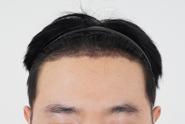 Yongin hair loss Hair Transplant Suwon MOMO HAIR TRANSPLANT incision 2000 Mo 2 weeks late