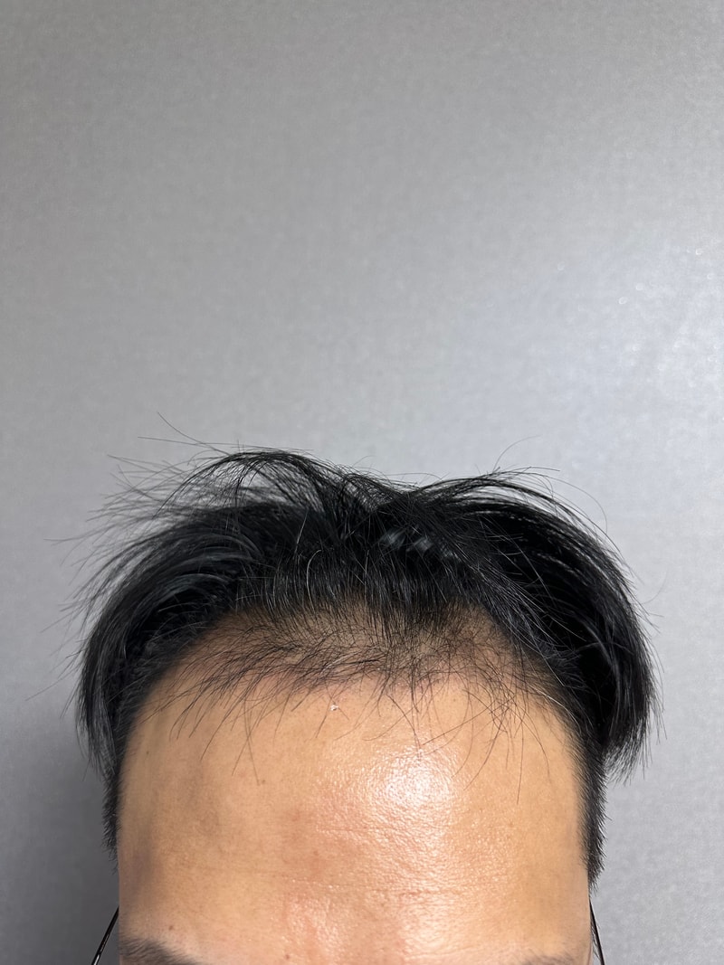 왜다들 비절개무삭발하는지 알겠네요.ㅎ 다나 4600모 90일 경과.ㅎ