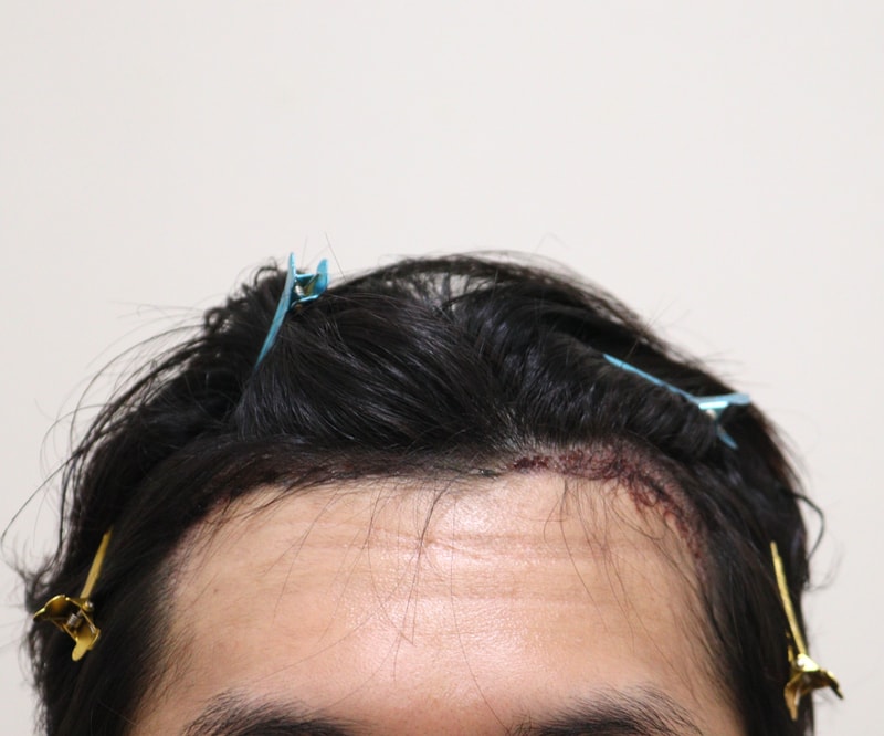 2. 수술후_1일_1.JPG