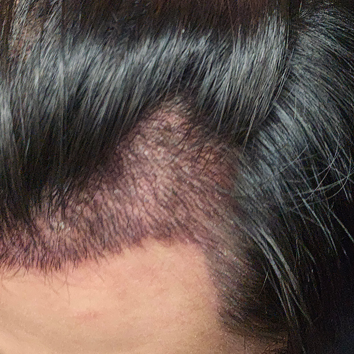 I had surgery in the m-shaped hairline correction country