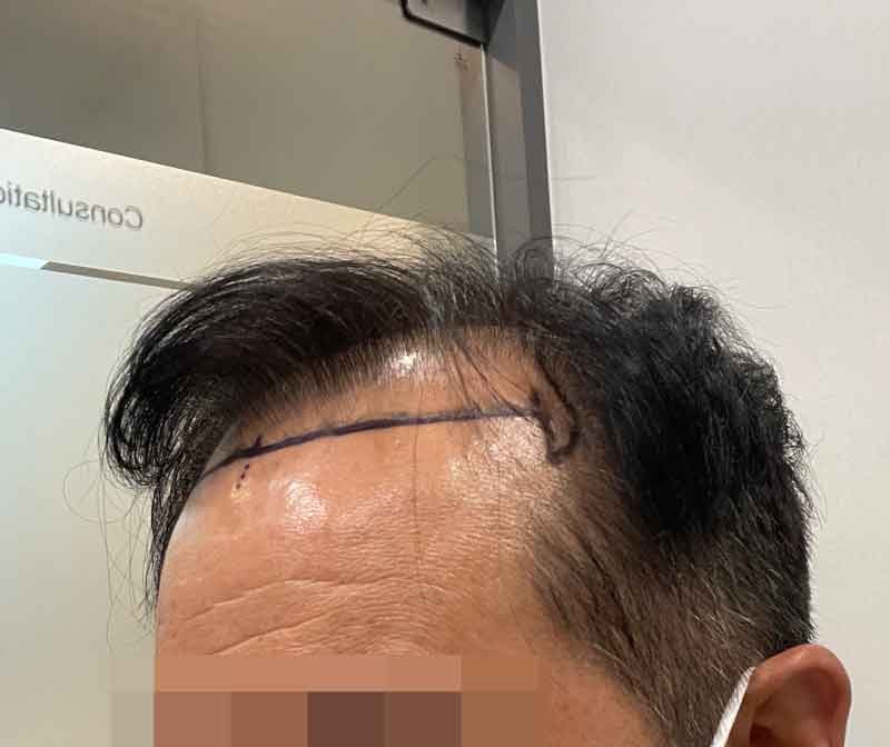 남들 3000모 할때 6000모 심은 결과 ^^ 다나성형외과 6000모 20개월