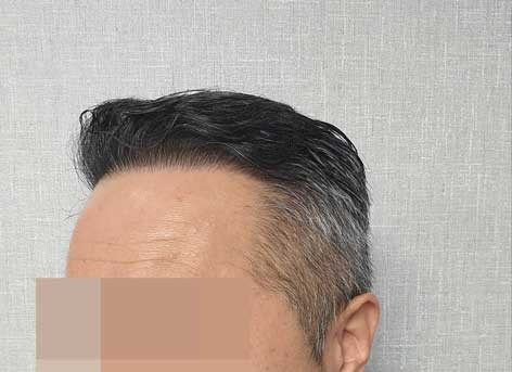 수술후~.jpg
