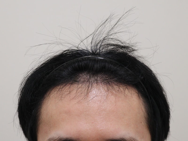 3. 수술후_6개월_1.JPG